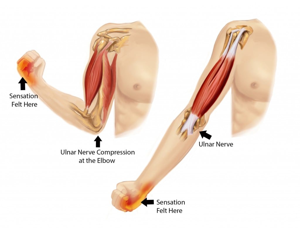 Cubital Tunnel Syndrome, STAR Physical Therapy, Tennessee