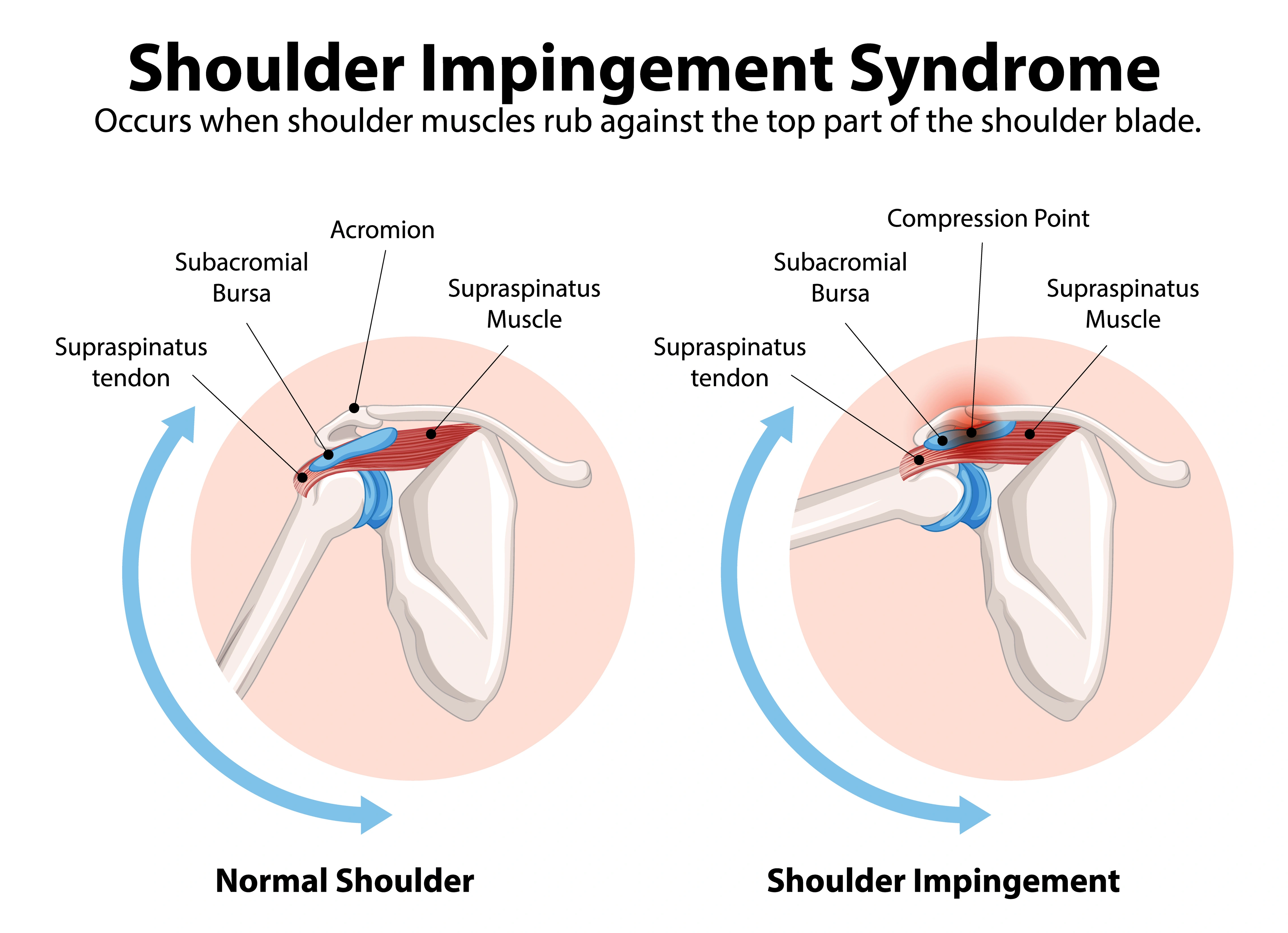 Shoulder Impingement Causes Symptoms And Treatment STAR Physical Shoulder Impingement Causes Symptoms And Treatment STAR Physical